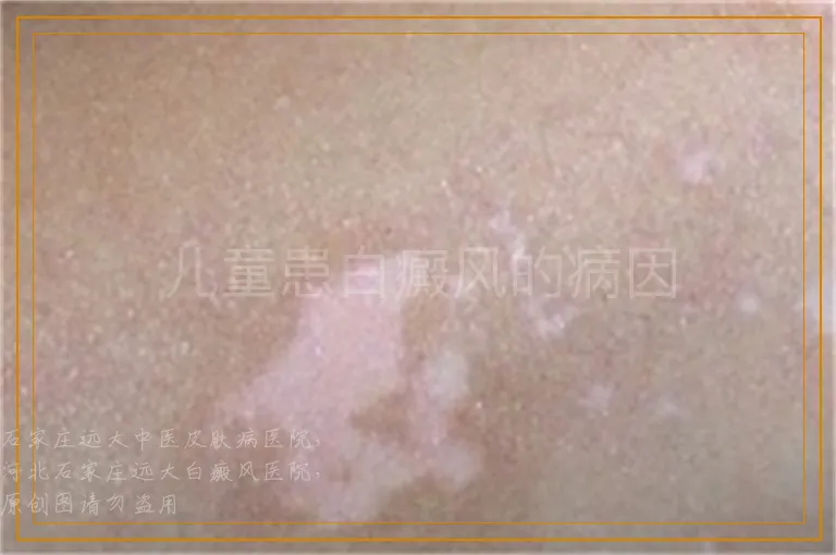 儿童患白癜风的病因