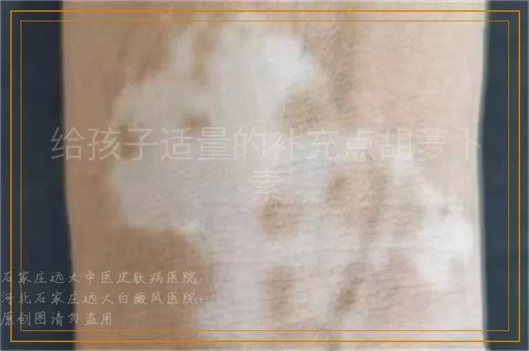 给孩子适量的补充点胡萝卜素