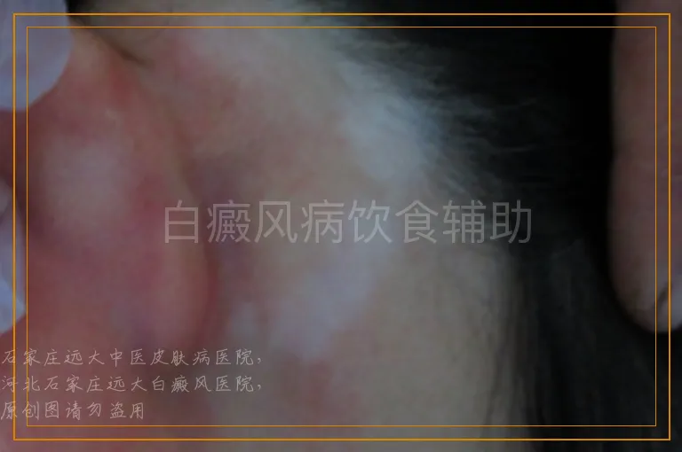 白癜风病饮食辅助
