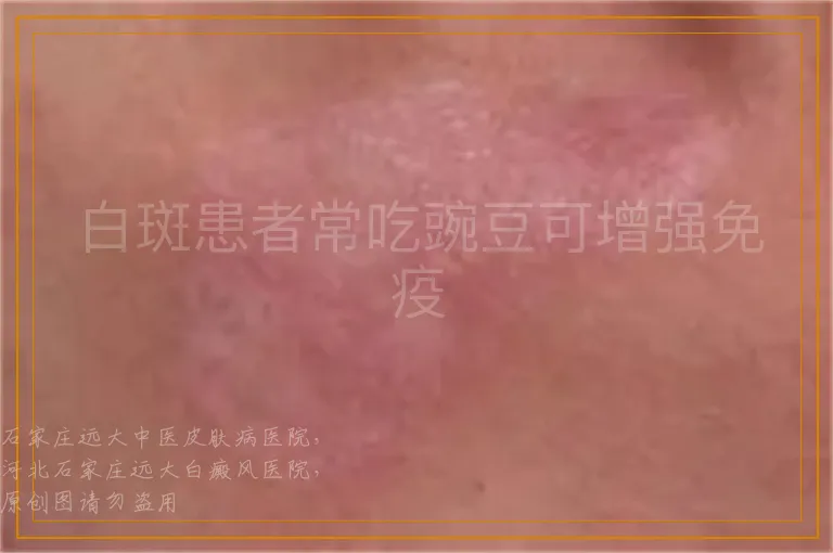 白斑患者常吃豌豆可增强免疫