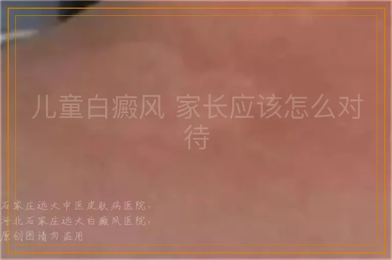 儿童白癜风 家长应该怎么对待
