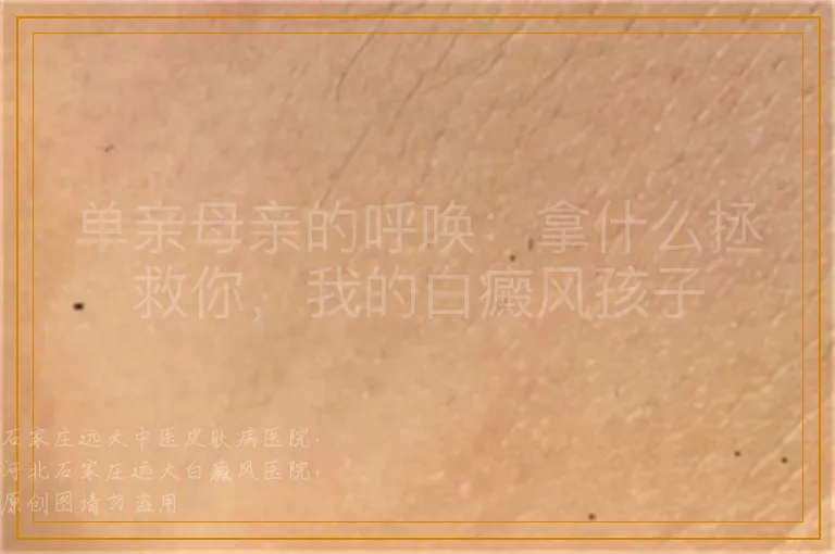 单亲母亲的呼唤：拿什么拯救你，我的白癜风孩子
