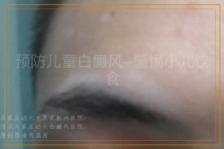 预防儿童白癜风-警惕小儿饮食