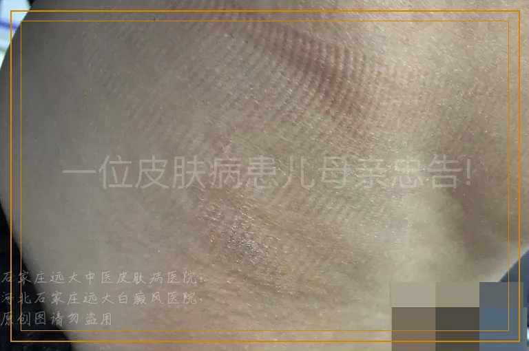 一位皮肤病患儿母亲忠告!