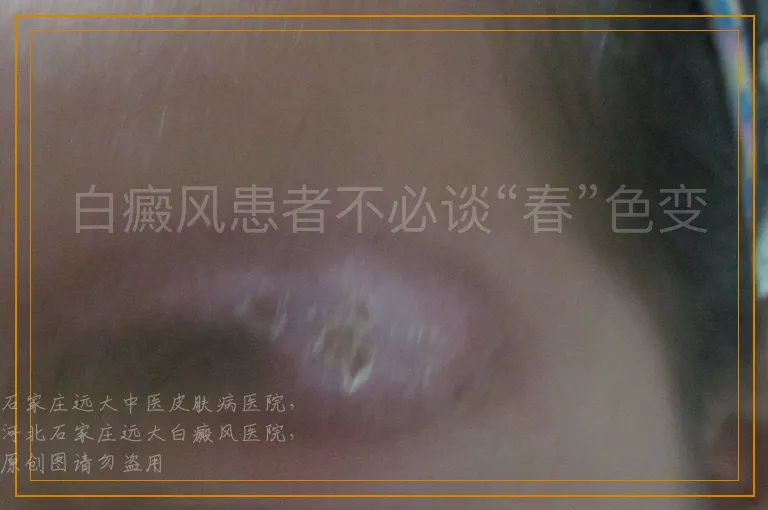 白癜风患者不必谈“春”色变