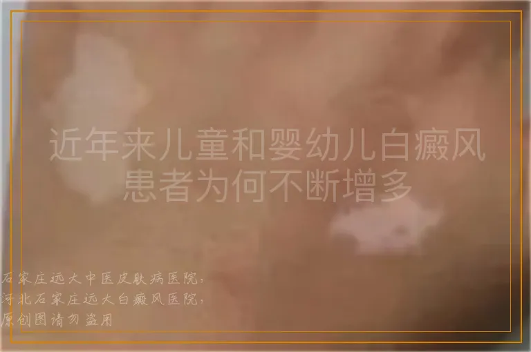 近年来儿童和婴幼儿白癜风患者为何不断增多