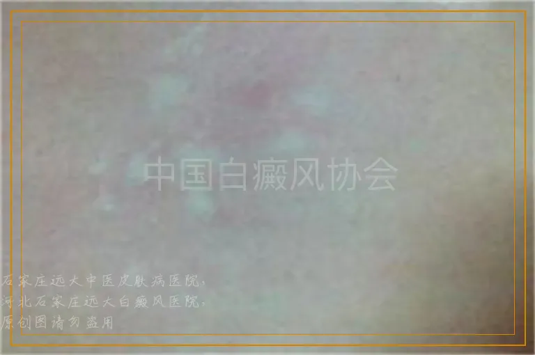 中国白癜风协会