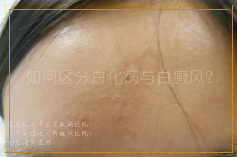 如何区分白化病与白癜风？