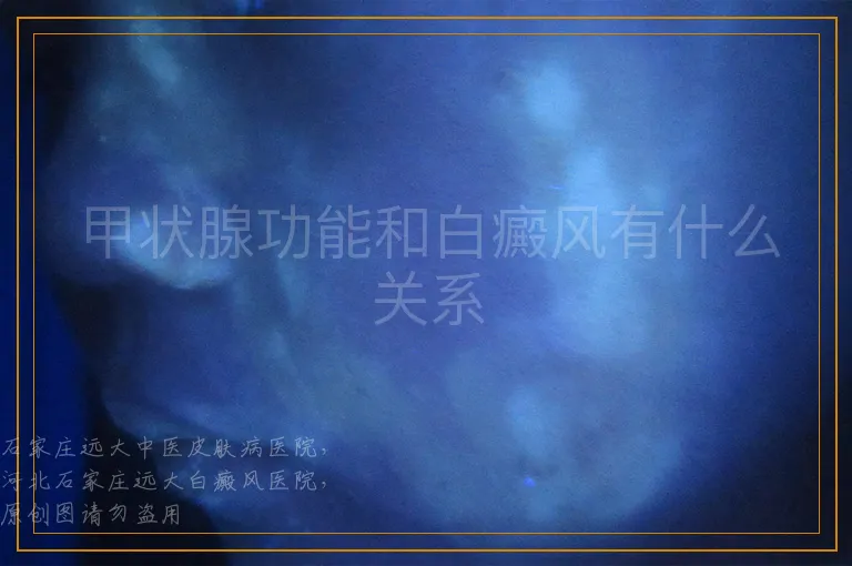 甲状腺功能和白癜风有什么关系