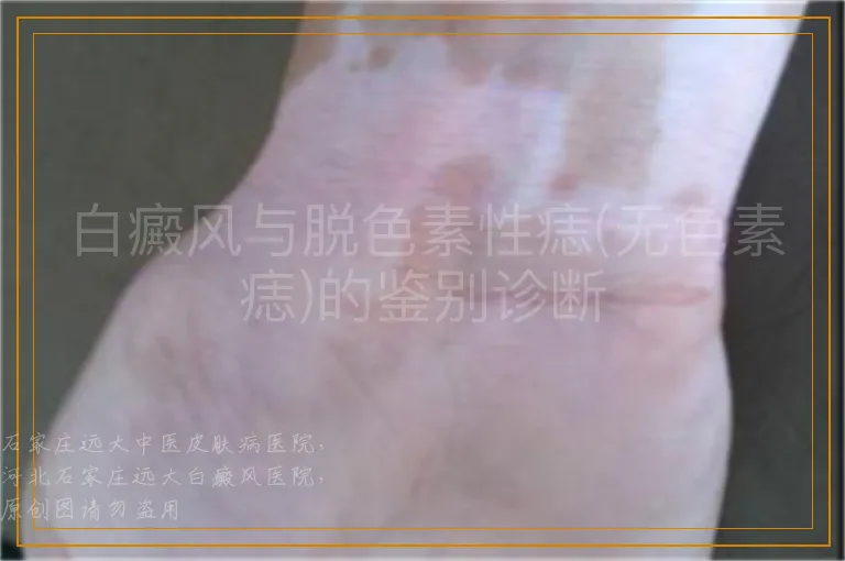 白癜风与脱色素性痣(无色素痣)的鉴别诊断