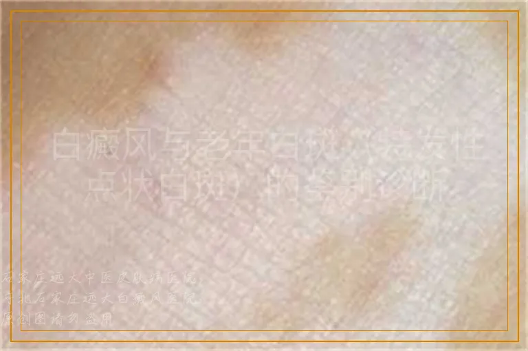 白癜风与老年白斑（特发性点状白斑）的鉴别诊断