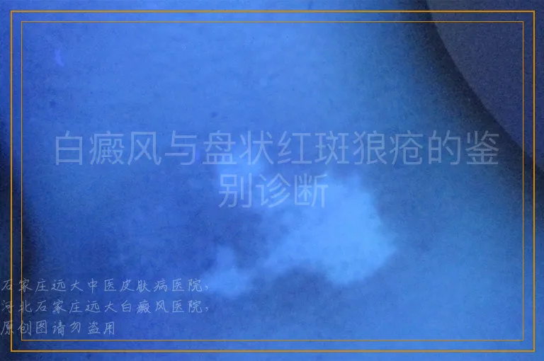 白癜风与盘状红斑狼疮的鉴别诊断