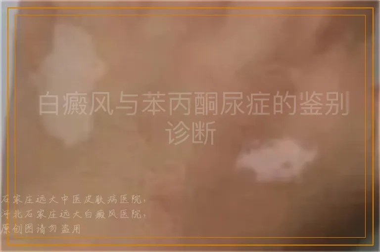 白癜风与苯丙酮尿症的鉴别诊断