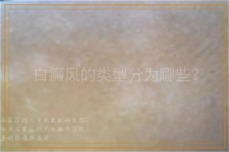 白癜风的类型分为哪些？