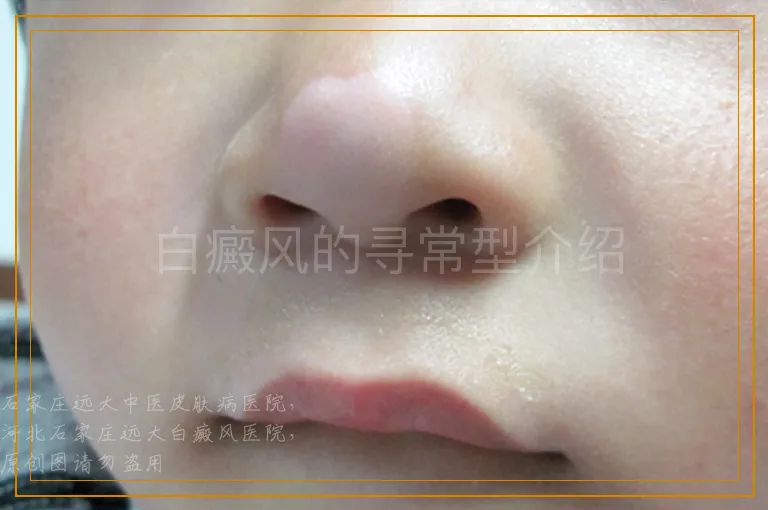 白癜风的寻常型介绍