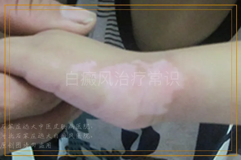 白癜风治疗常识