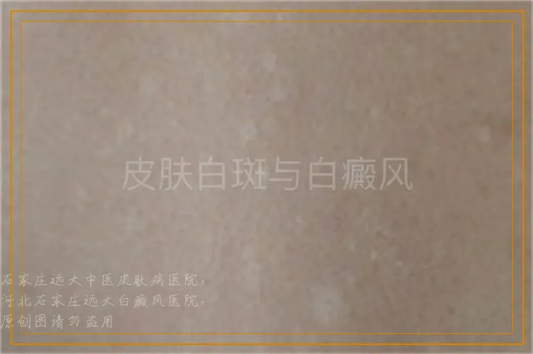 皮肤白斑与白癜风