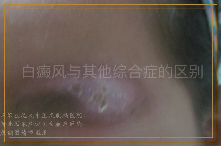 白癜风与其他综合症的区别