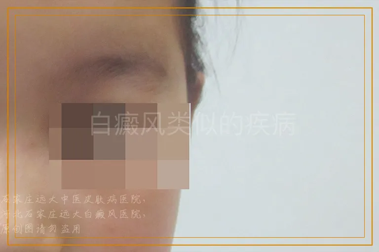 白癜风类似的疾病