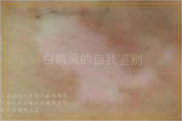 白癜风的自我鉴别
