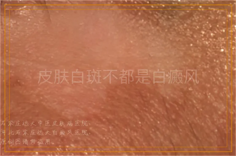 皮肤白斑不都是白癜风