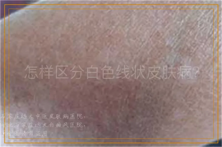 怎样区分白色线状皮肤病？
