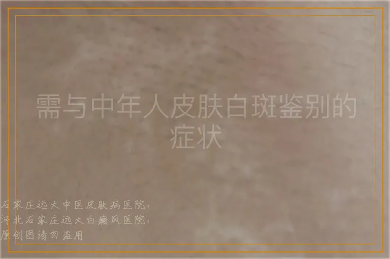需与中年人皮肤白斑鉴别的症状