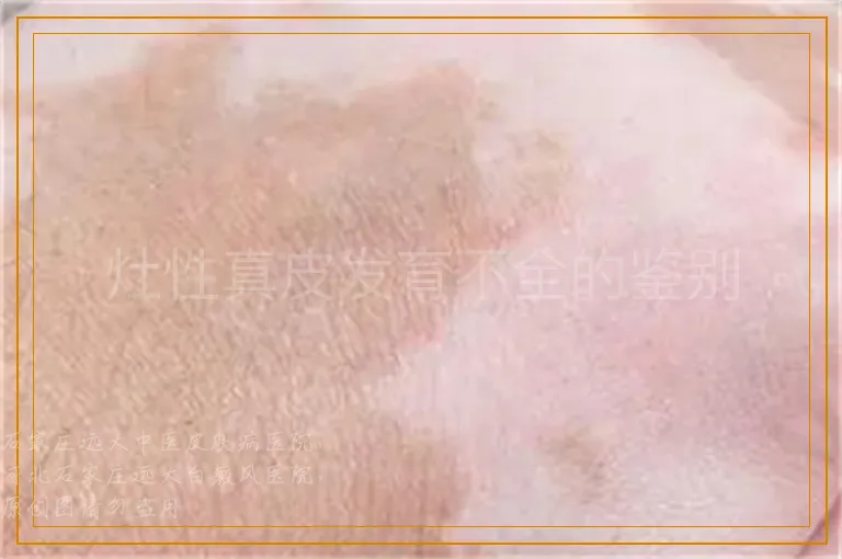 灶性真皮发育不全的鉴别