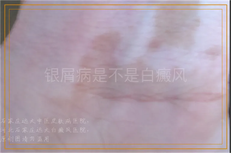 银屑病是不是白癜风