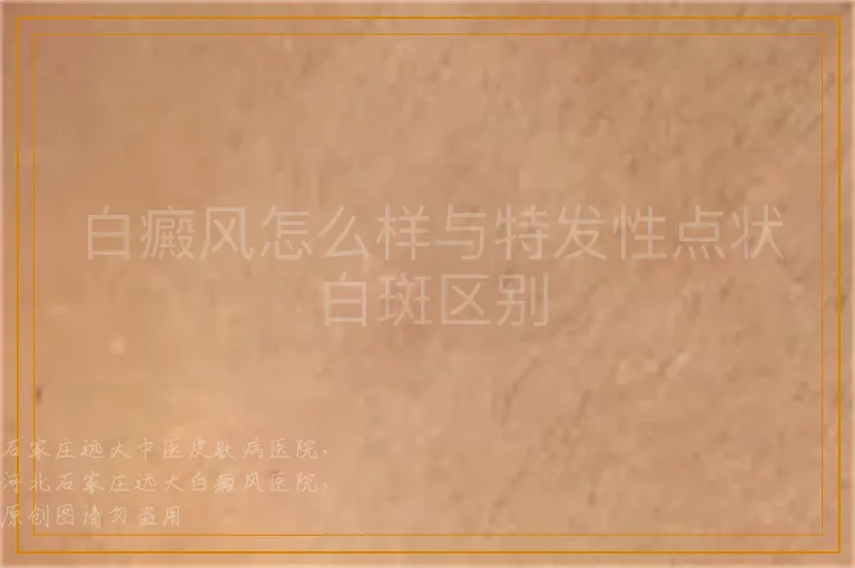 白癜风怎么样与特发性点状白斑区别