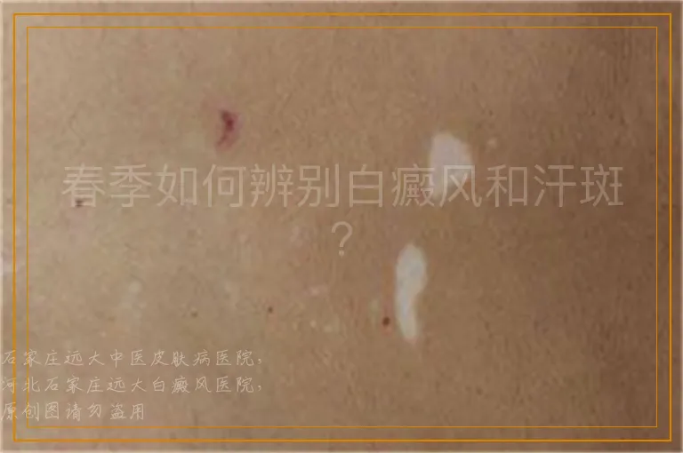 春季如何辨别白癜风和汗斑？