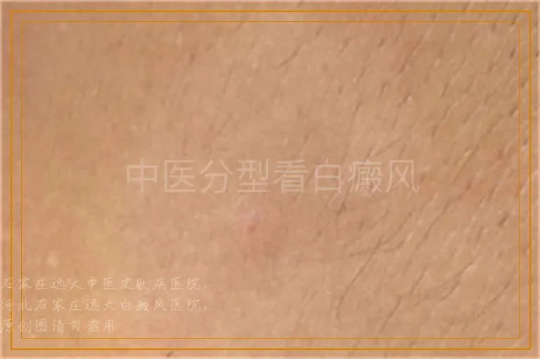 中医分型看白癜风