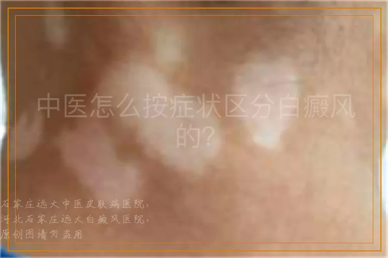 中医怎么按症状区分白癜风的？