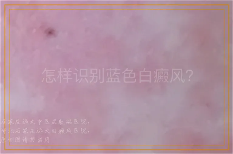怎样识别蓝色白癜风？