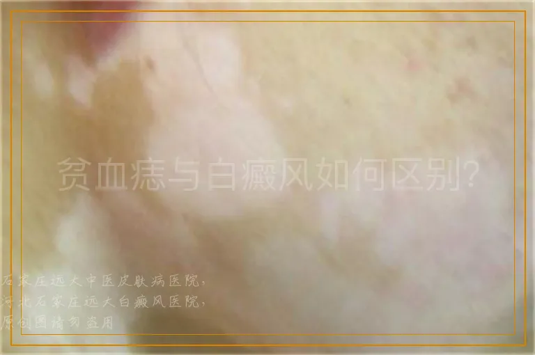 贫血痣与白癜风如何区别？