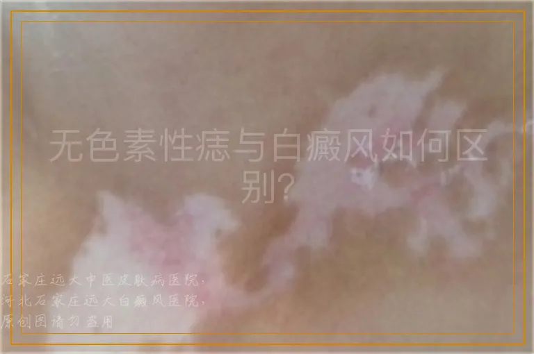 无色素性痣与白癜风如何区别？