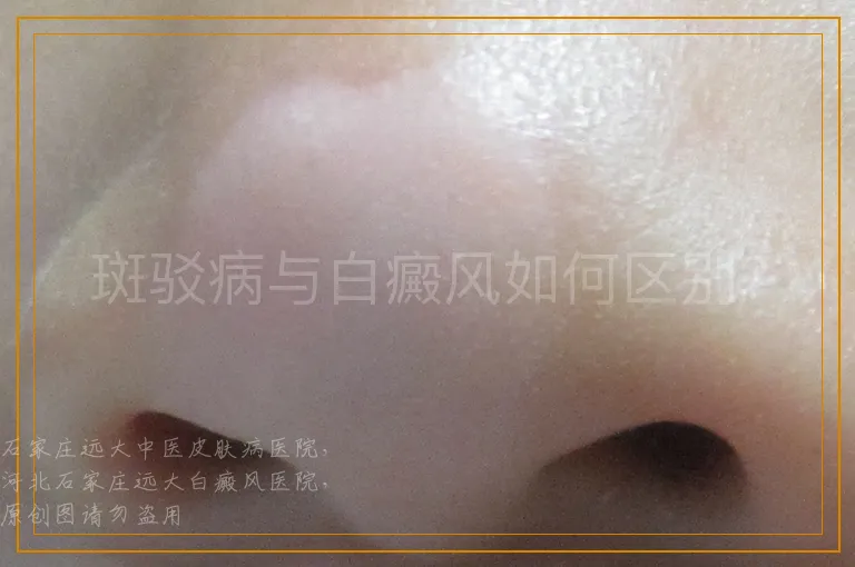 斑驳病与白癜风如何区别？