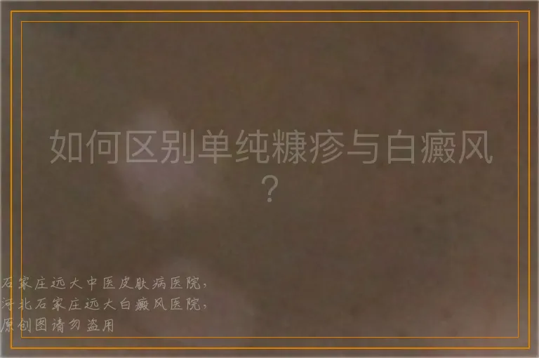 如何区别单纯糠疹与白癜风？
