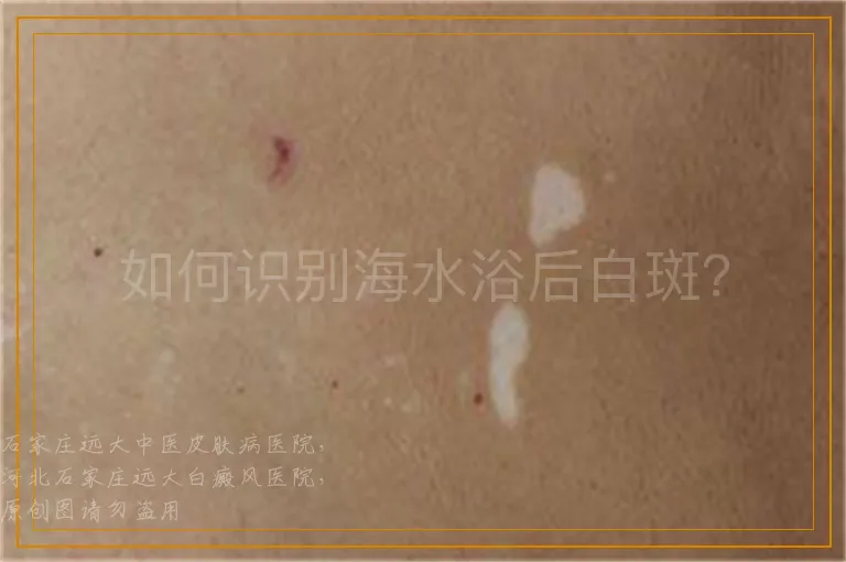 如何识别海水浴后白斑？