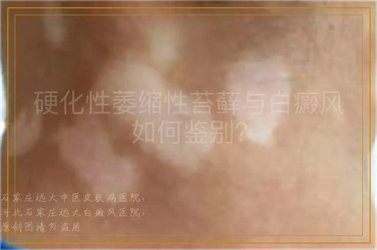 硬化性萎缩性苔藓与白癜风如何鉴别？