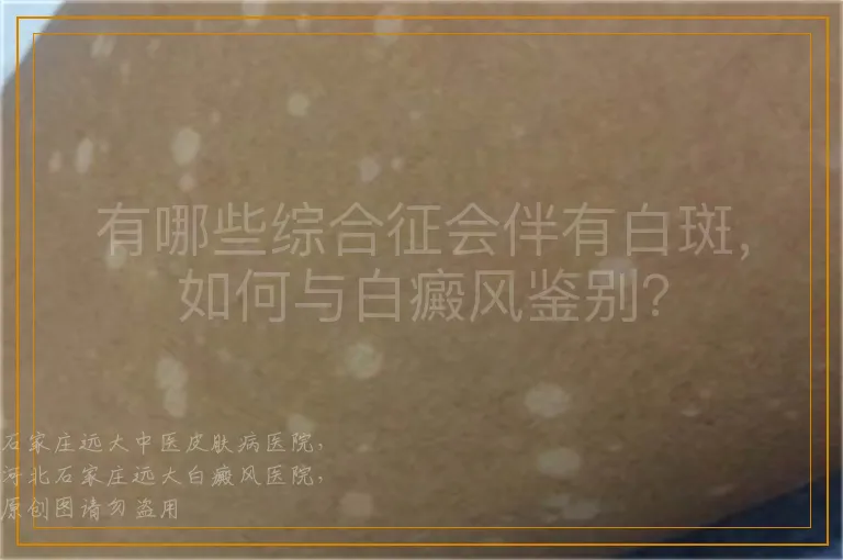 有哪些综合征会伴有白斑，如何与白癜风鉴别？