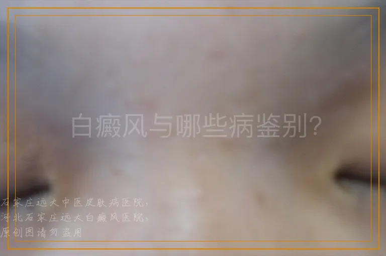 白癜风与哪些病鉴别?