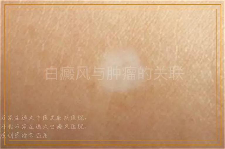白癜风与肿瘤的关联