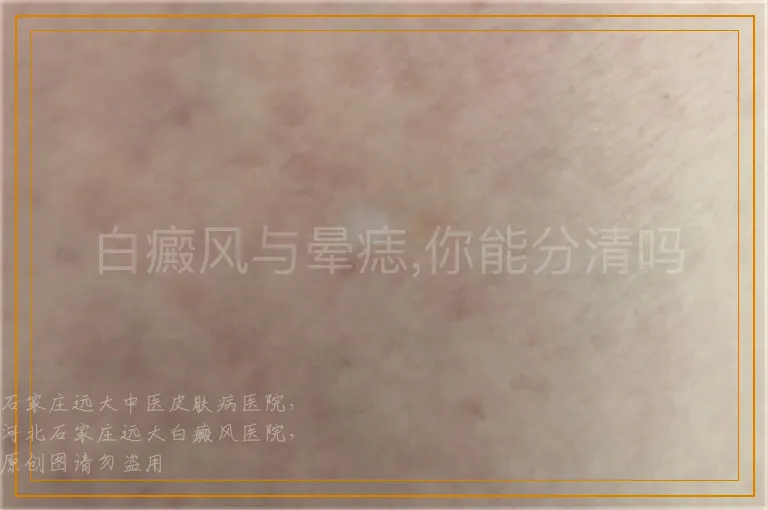 白癜风与晕痣,你能分清吗
