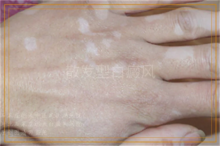 散发型白癜风