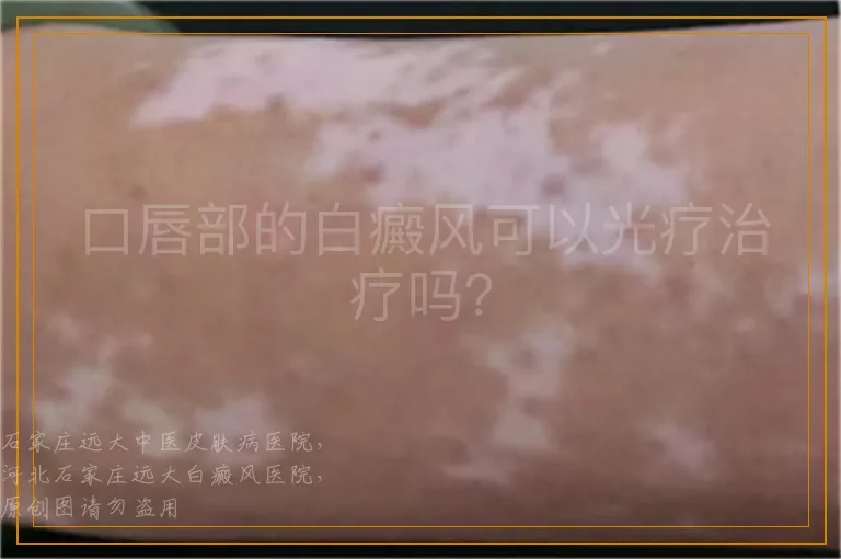 口唇部的白癜风可以光疗治疗吗？