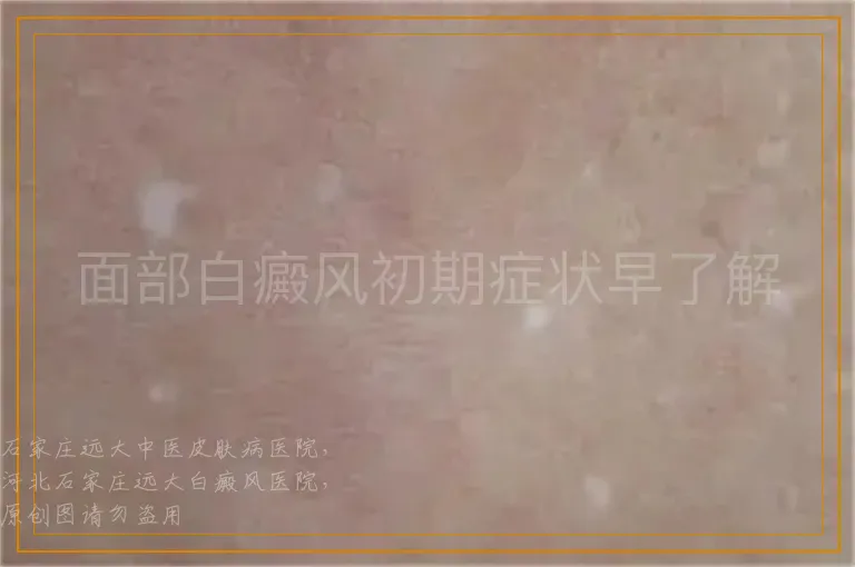 面部白癜风初期症状早了解