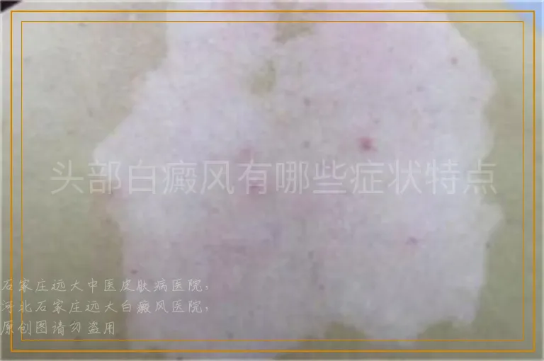 头部白癜风有哪些症状特点