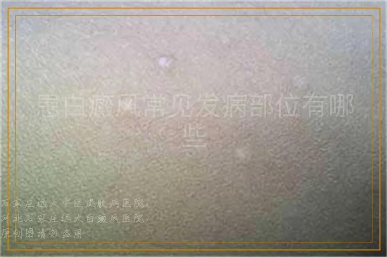 患白癜风常见发病部位有哪些