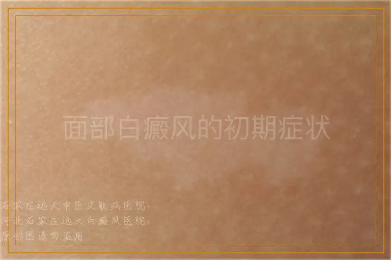面部白癜风的初期症状